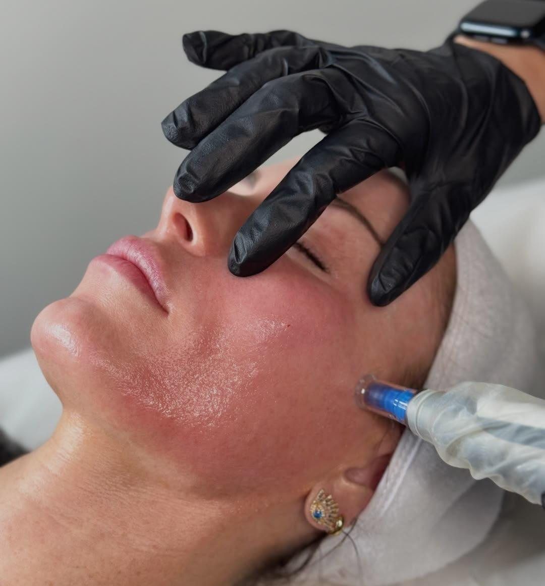Microneedling-Behandlung im Gesicht